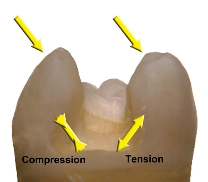 When is the One Visit Crown a suitable treatment for cracked teeth or